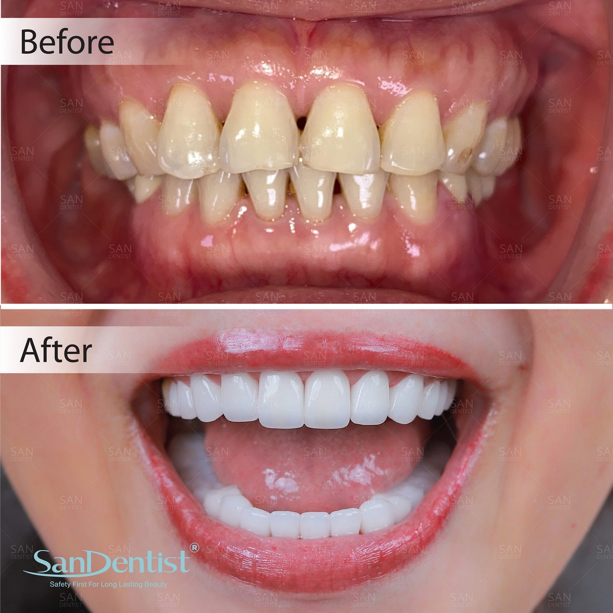 Răng thưa: Nguyên nhân gây ra và những cách xử lý