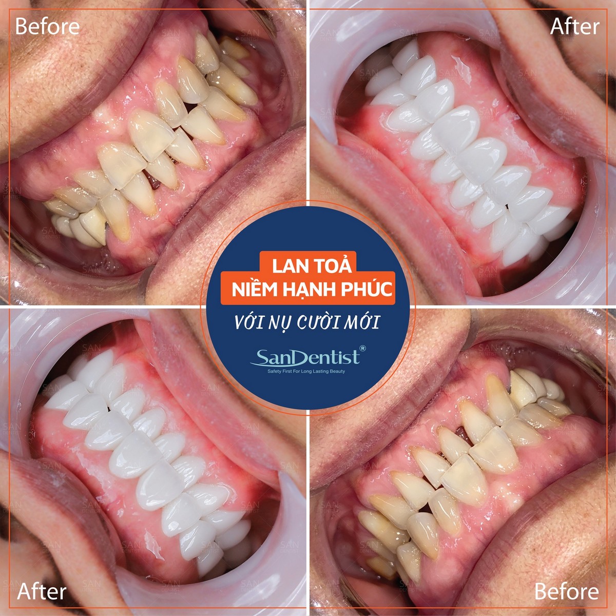 Răng thưa: Nguyên nhân gây ra và những cách xử lý