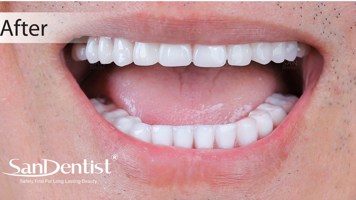 Mất 1 răng, nên làm cầu răng sứ hay trồng răng implant?