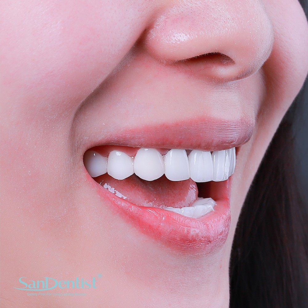 Khuyết cổ chân răng là bệnh gì? Khắc phục ra sao?