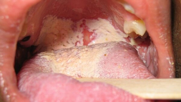 Người bị tiểu đường dễ mắc nhiều bệnh răng miệng hơn