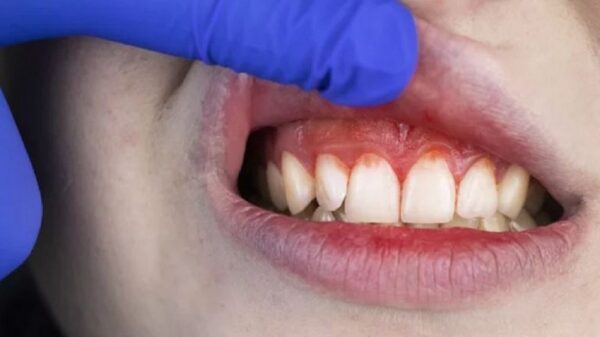 Bệnh viêm nướu gồm các giai đoạn nào? Có lây nhiễm không?