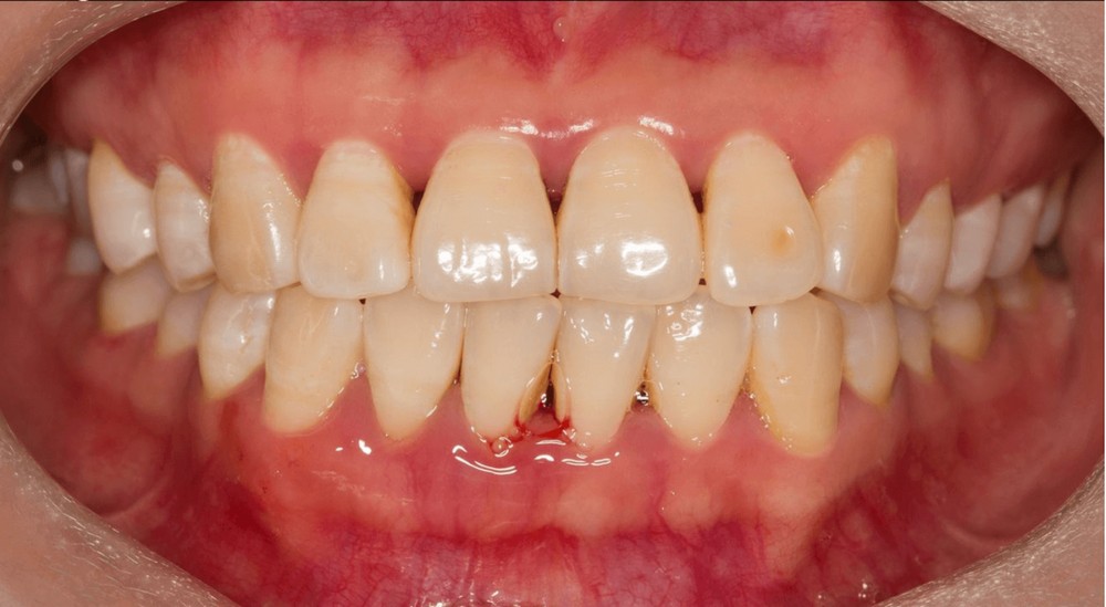 Bệnh viêm nướu gồm các giai đoạn nào? Có lây nhiễm không?