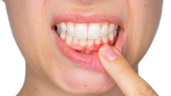 Bệnh viêm nướu có những triệu chứng thường gặp nào?