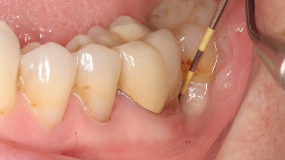 Bệnh viêm quanh răng: Nguyên nhân và biện pháp điều trị