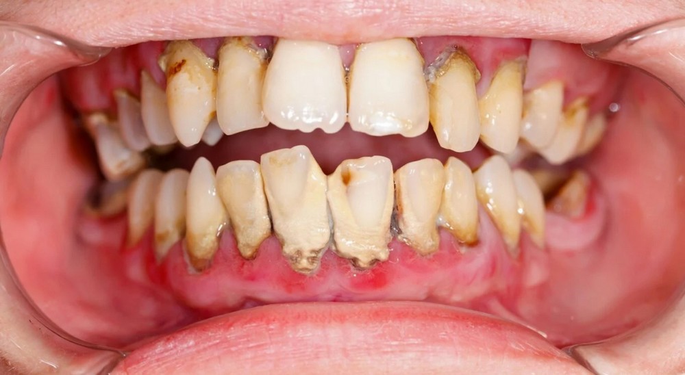 Bệnh viêm quanh răng: Nguyên nhân và biện pháp điều trị