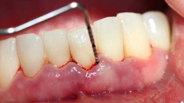 Những cách điều trị bệnh viêm nướu hiệu quả