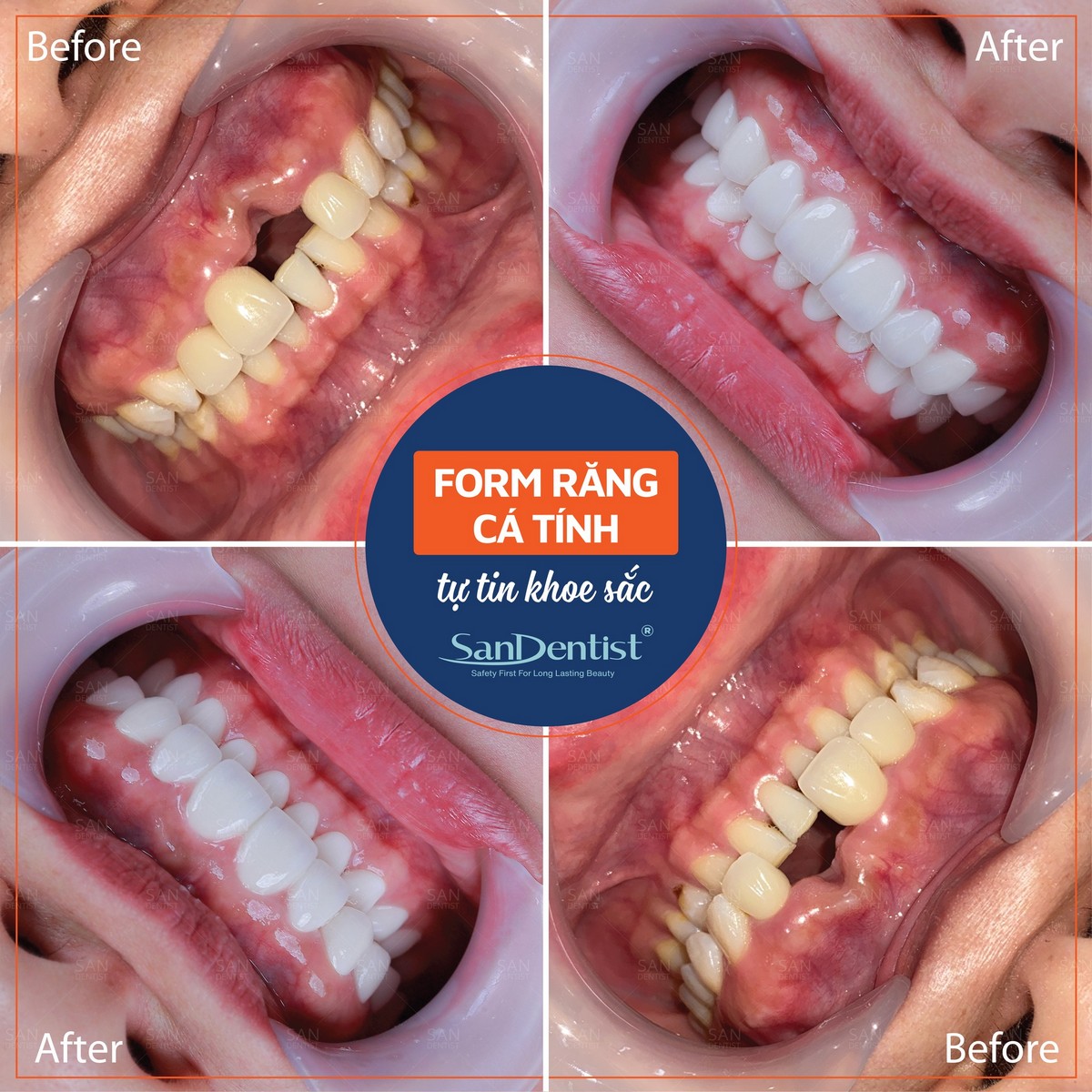 Người lớn tuổi mất răng: Làm sao để cải thiện ăn nhai?