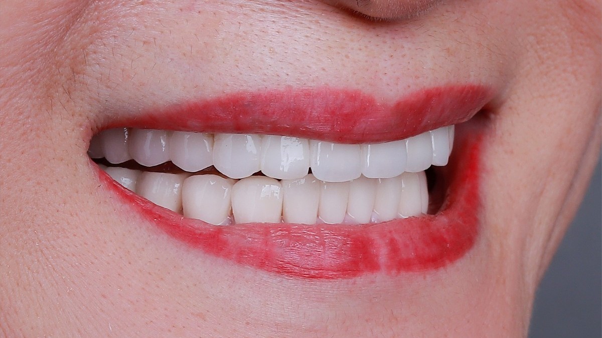 Người lớn tuổi mất răng: Làm sao để cải thiện ăn nhai?