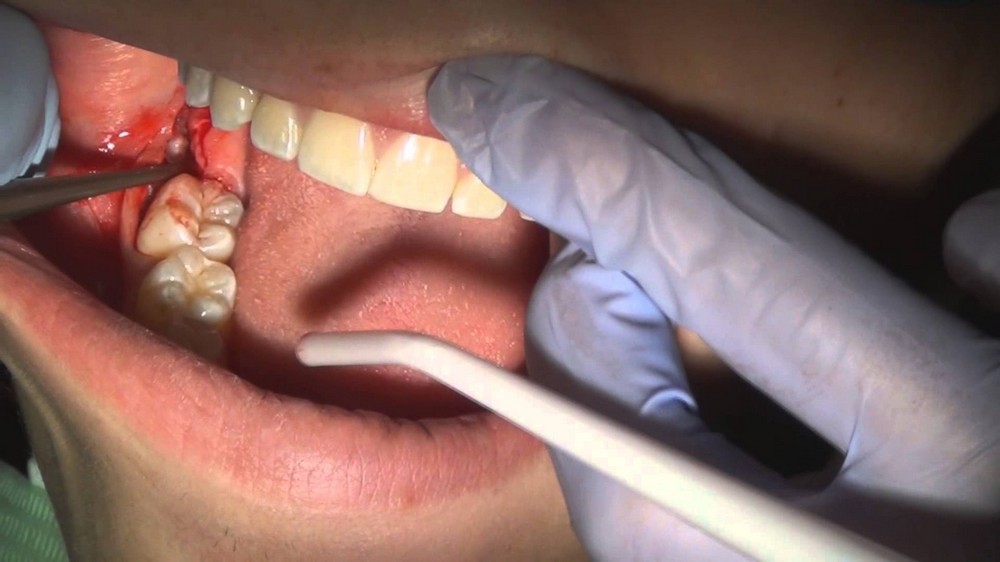 Chăm sóc vết thương do nhổ răng khôn đúng cách