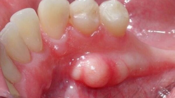 Lồi xương hàm: Cách nhận biết và phương pháp điều trị
