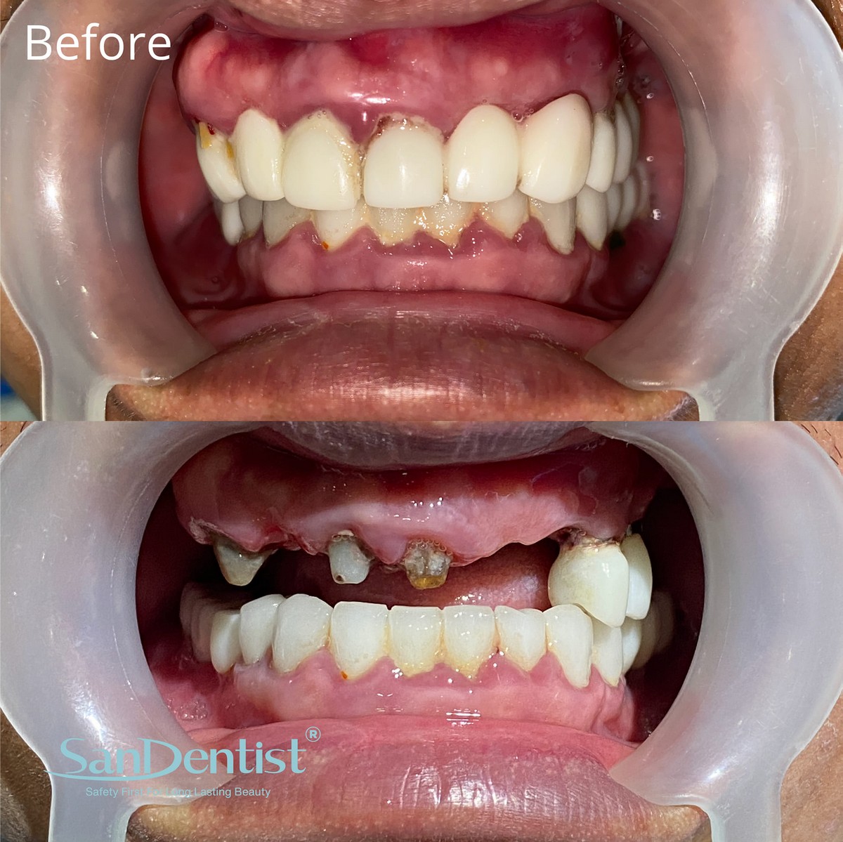 Bệnh mòn cổ răng là gì? Ảnh hưởng ra sao tới cơ thể?