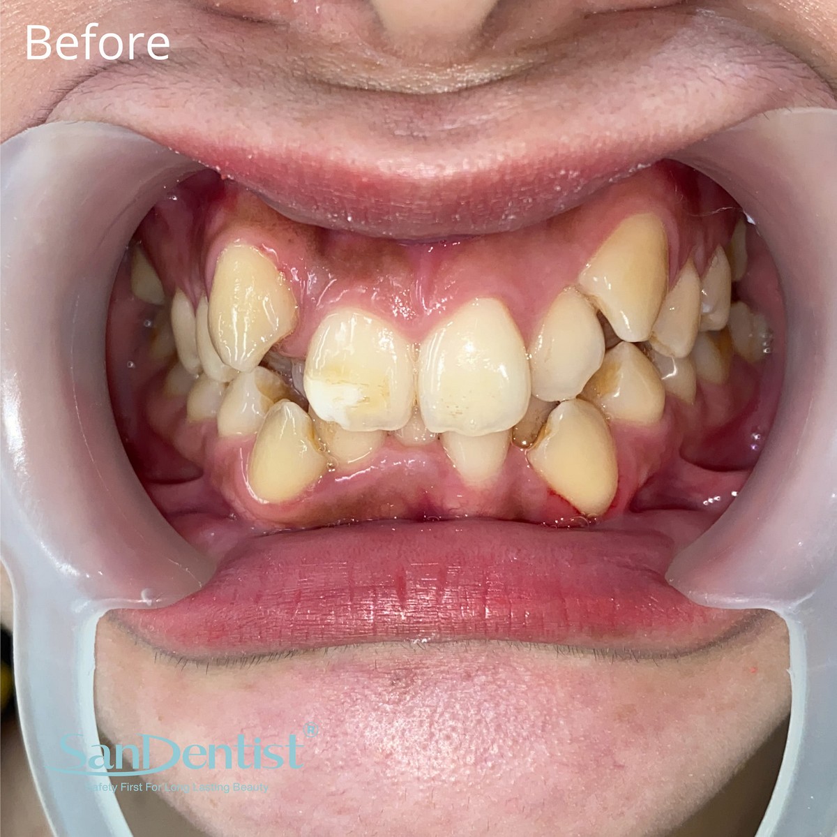 Bệnh mòn cổ răng là gì? Ảnh hưởng ra sao tới cơ thể?