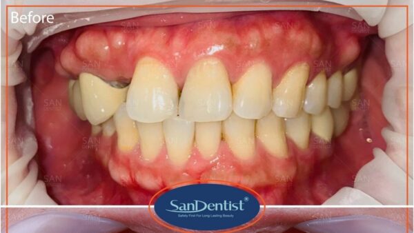 Bệnh mòn cổ răng là gì? Ảnh hưởng ra sao tới cơ thể?