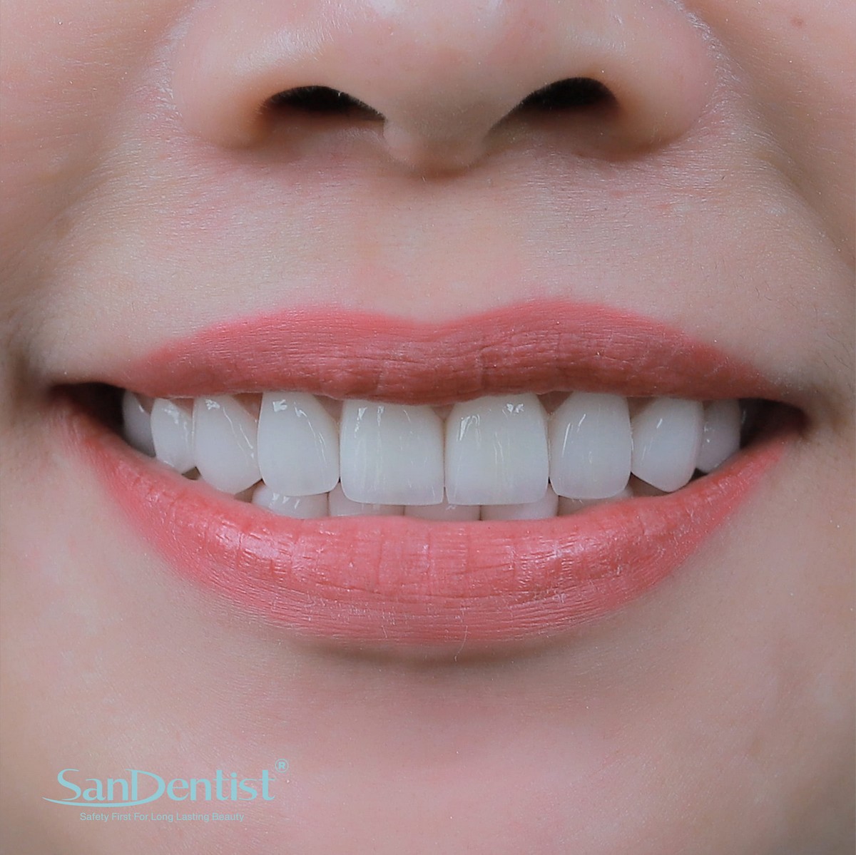 Sốc: Chạy bộ có thể là nguyên nhân gây mòn men răng!