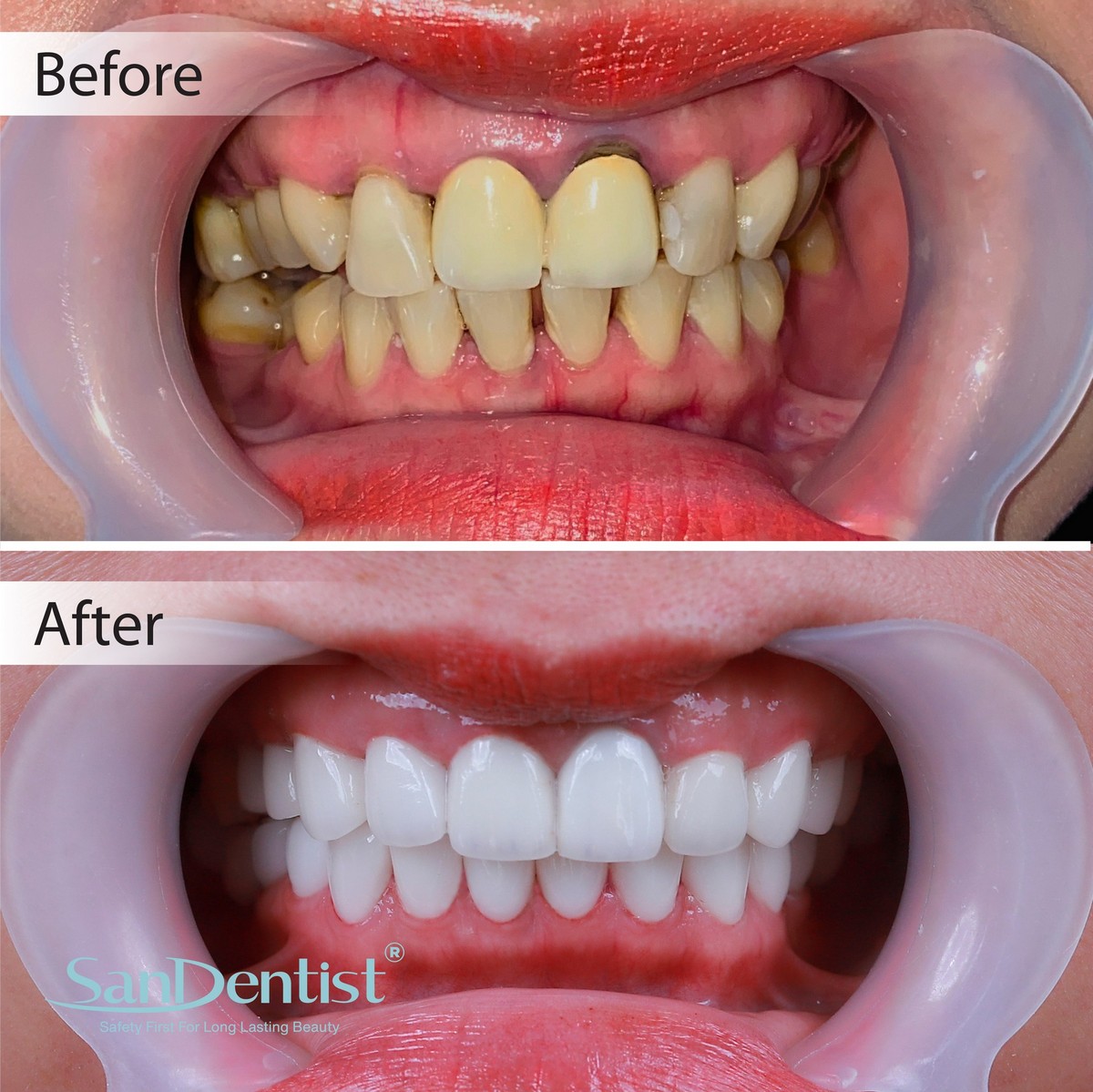 Nguyên nhân lợi thâm đen và biện pháp điều trị hiệu quả