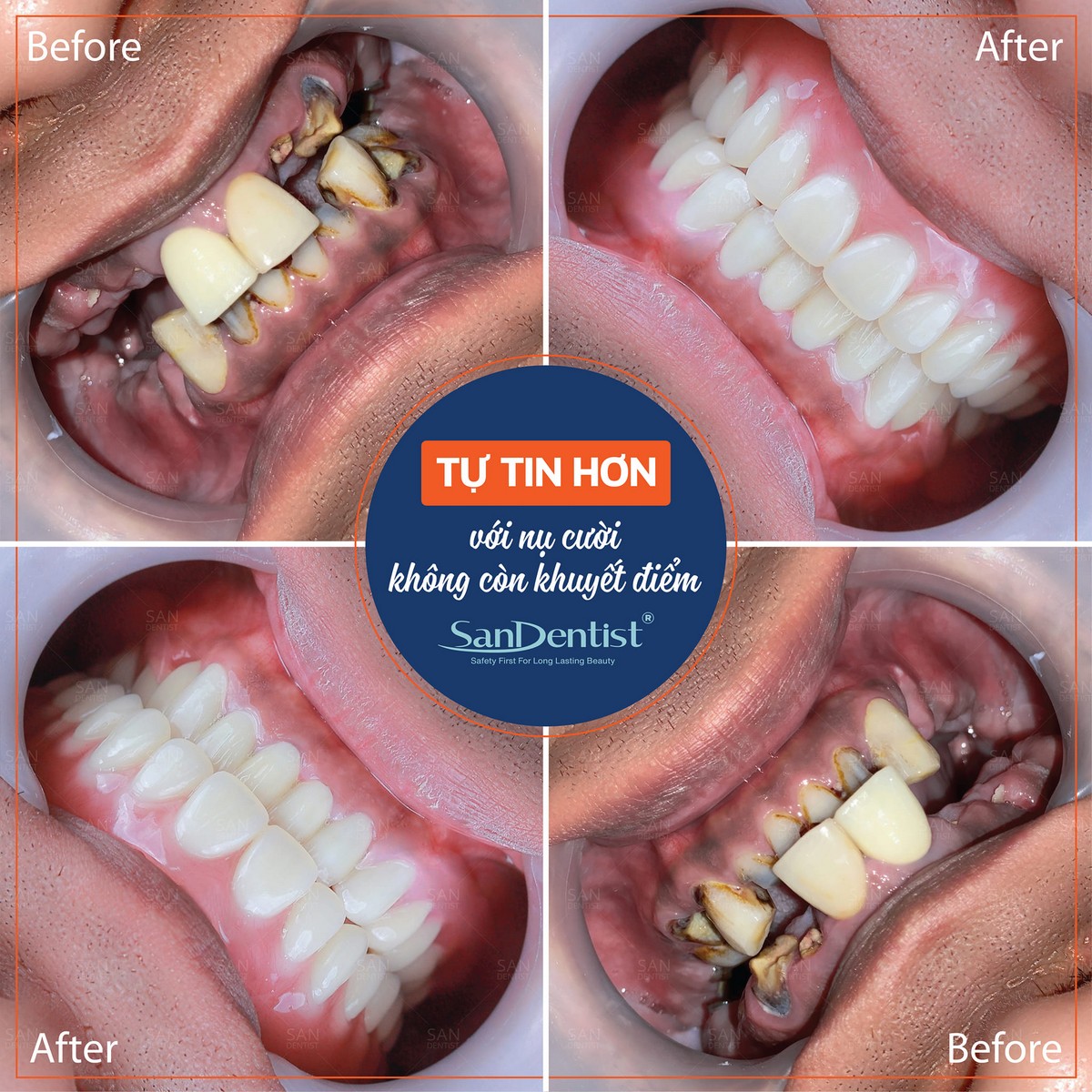 Nguyên nhân lợi thâm đen và biện pháp điều trị hiệu quả