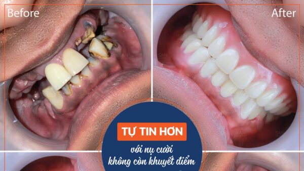 Nguyên nhân lợi thâm đen và biện pháp điều trị hiệu quả