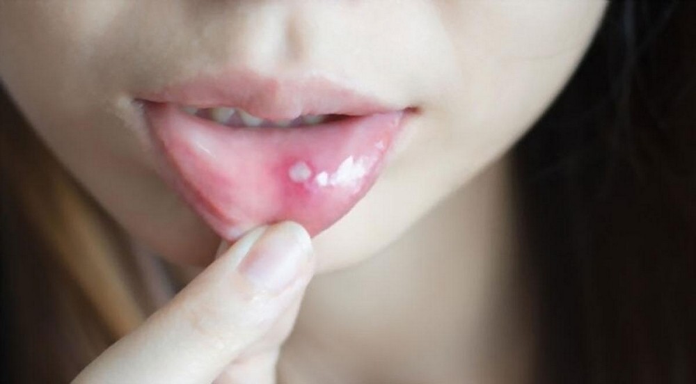 Thiếu chất dinh dưỡng là nguyên nhân gây ra nhiệt miệng