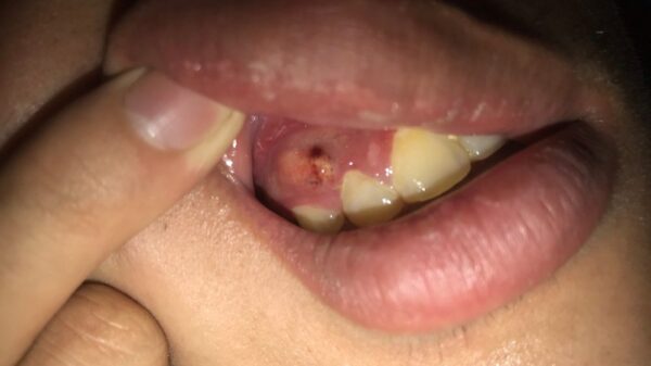 Bệnh nha chu và những dấu hiệu phổ biến thường gặp