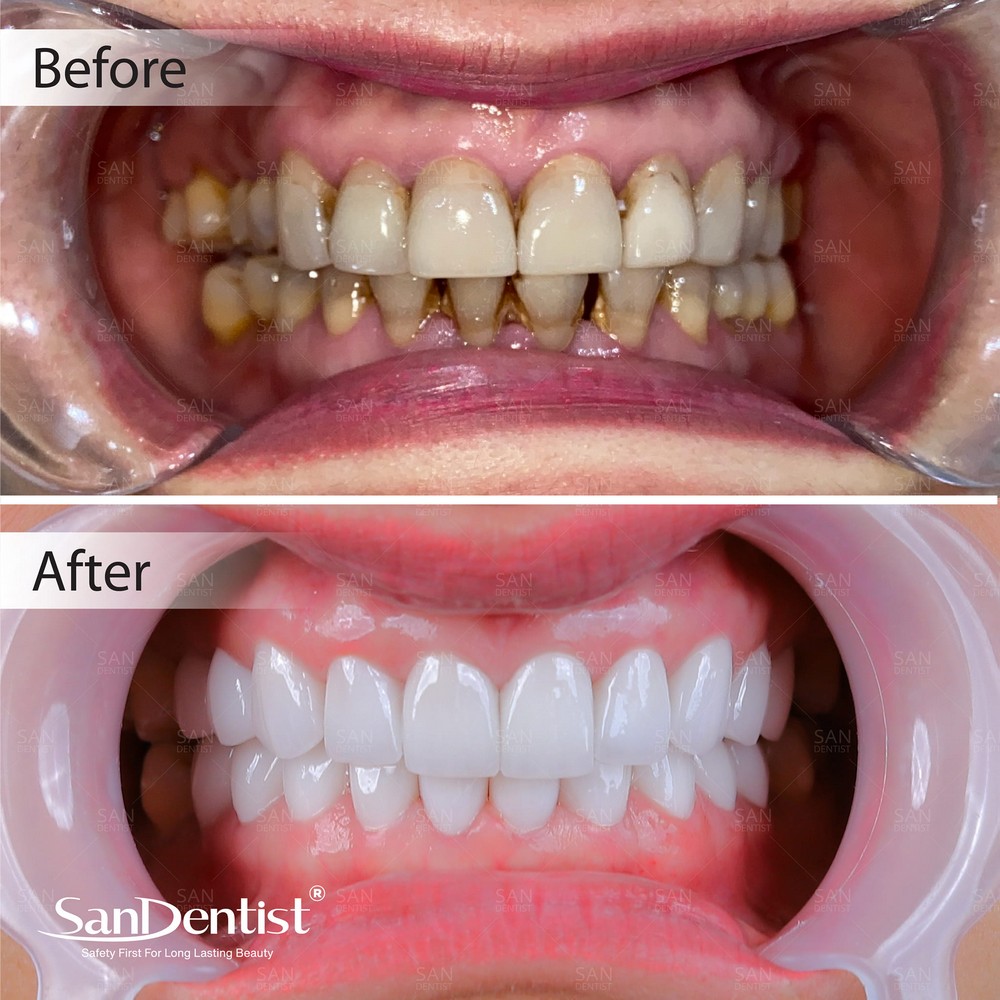 Bệnh nha chu và những dấu hiệu phổ biến thường gặp