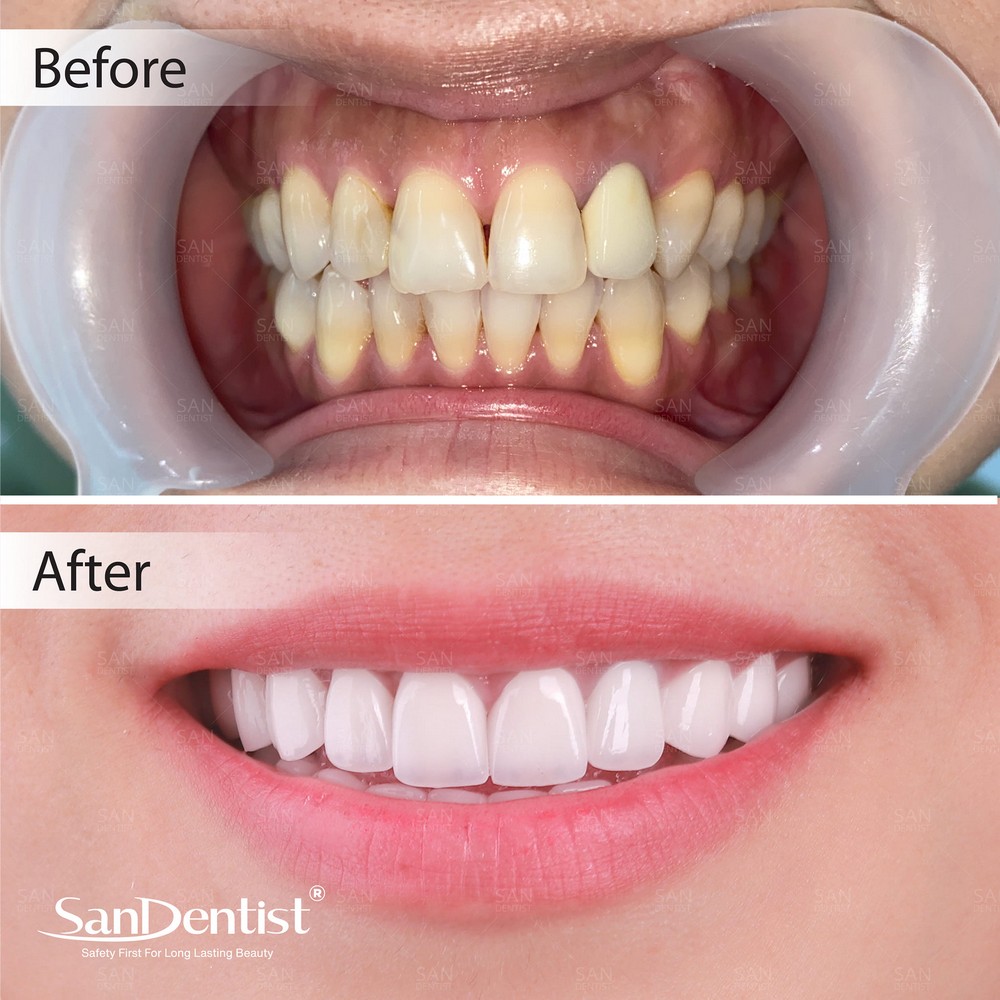 Nướu răng nổi cục thịt: Nguyên nhân và cách điều trị