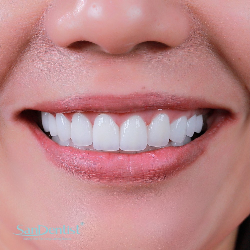 Răng bị mục gây ảnh hưởng ra sao đến cơ thể?