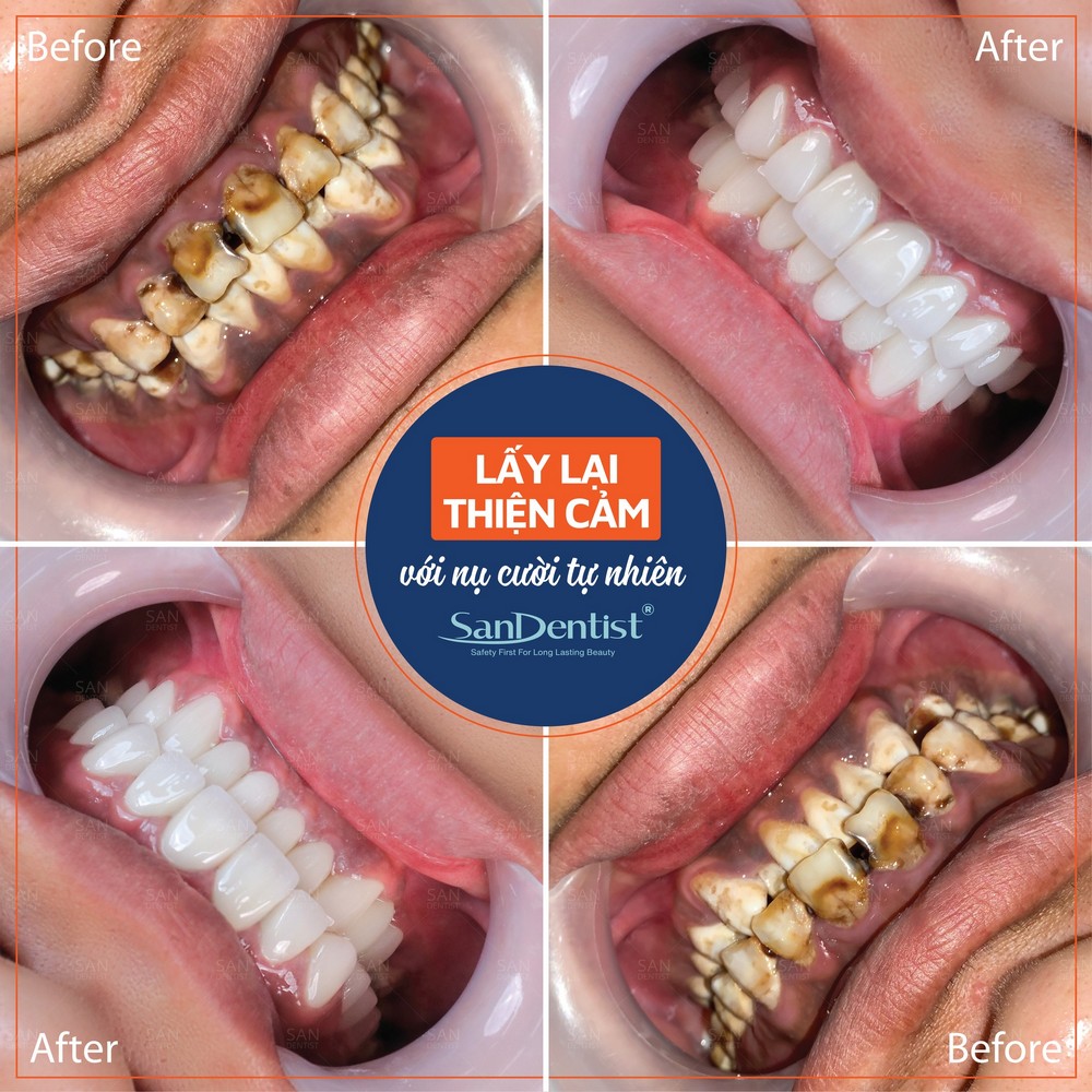 Răng bị mục gây ảnh hưởng ra sao đến cơ thể?