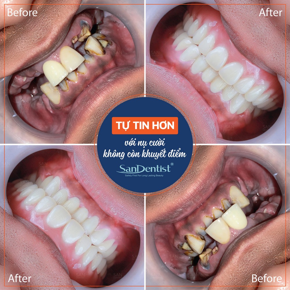 Răng bị mục gây ảnh hưởng ra sao đến cơ thể?