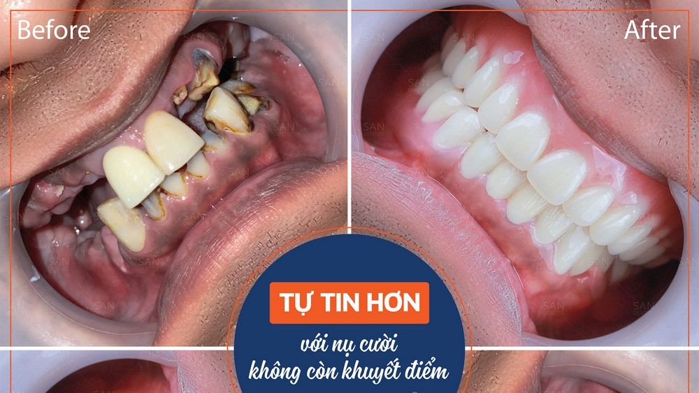 Răng bị mục gây ảnh hưởng ra sao đến cơ thể?