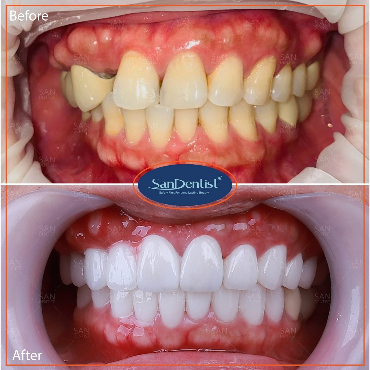 Răng lung lay và biện pháp khắc phục hiệu quả