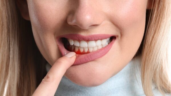 Mối liên hệ giữa bệnh tim mạch và bệnh nha chu