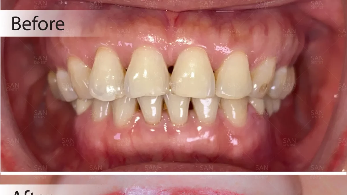 3 phương pháp điều trị răng hô mà không cần niềng