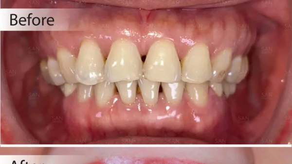 3 phương pháp điều trị răng hô mà không cần niềng