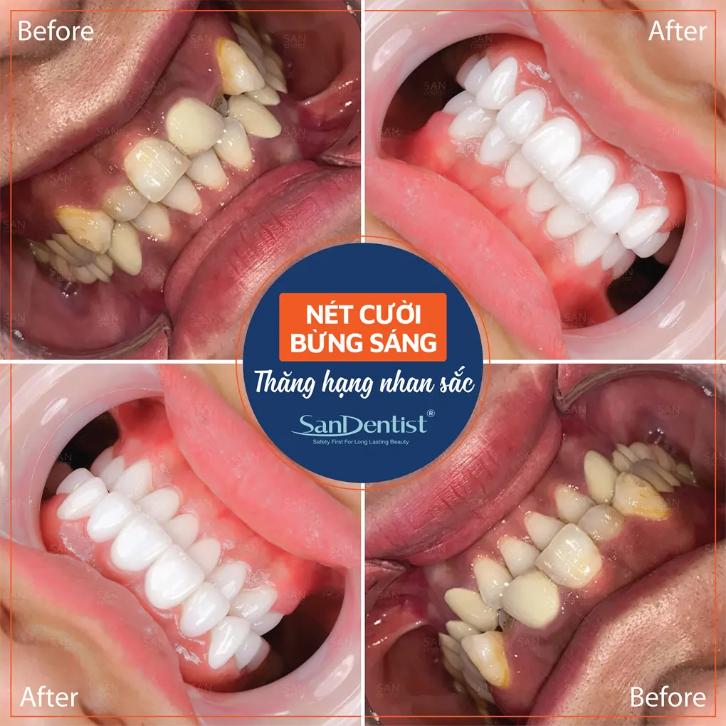3 phương pháp điều trị răng hô mà không cần niềng