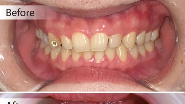 Cười hở lợi được điều trị như thế nào?