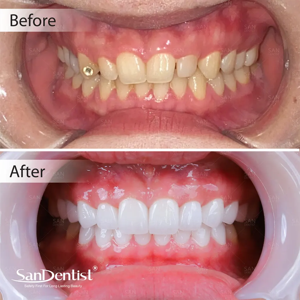 Cười hở lợi được điều trị như thế nào?