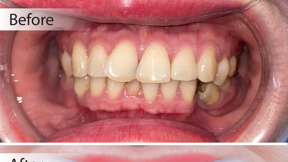 Ngà răng nhạy cảm: Nguyên nhân và cách phòng ngừa