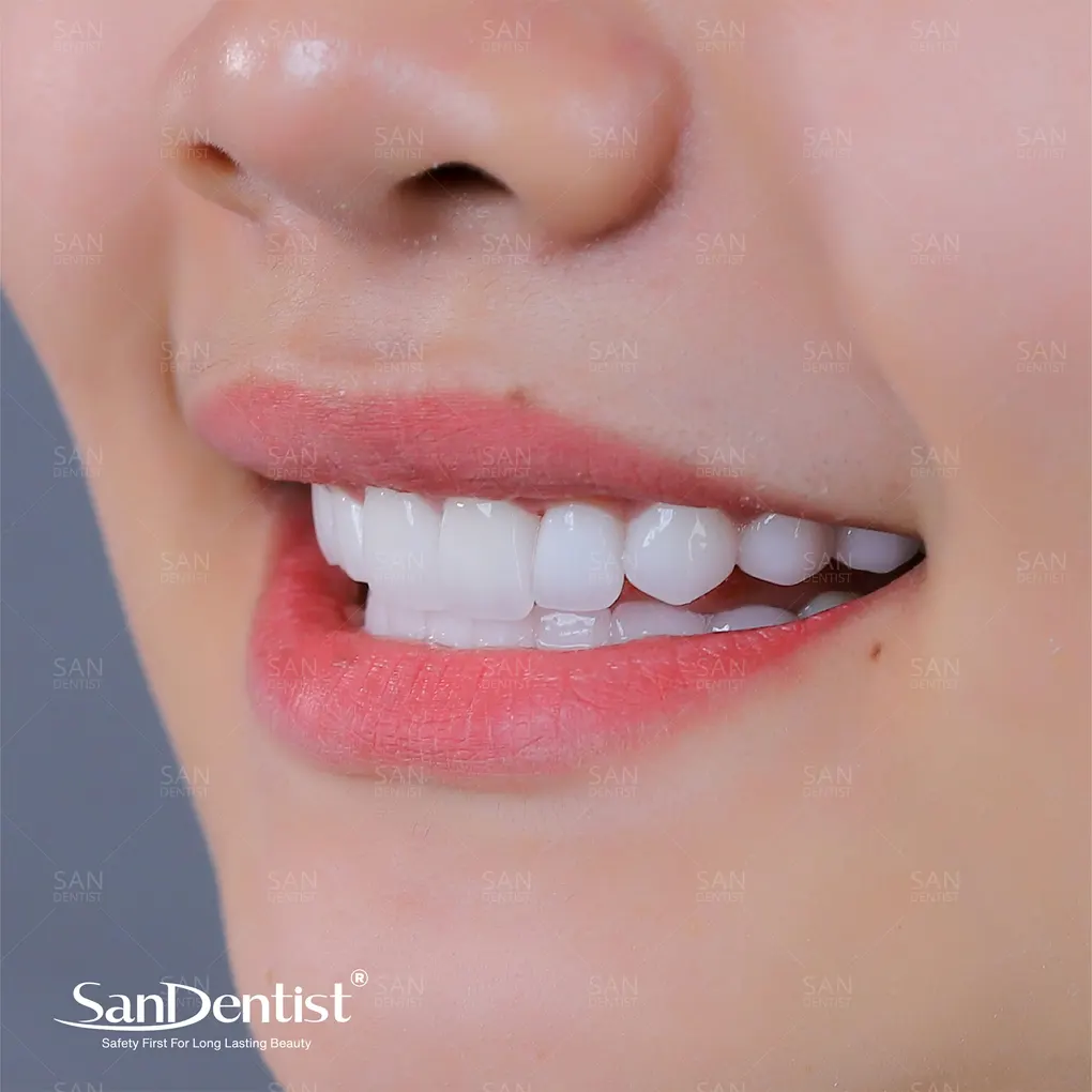 Ngà răng nhạy cảm: Nguyên nhân và cách phòng ngừa