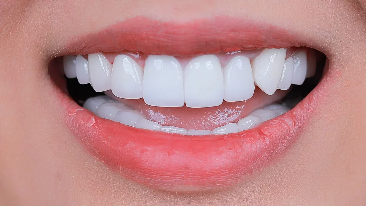 Phủ sứ răng hàm là gì? Có điều trị bệnh lý răng được không? 
