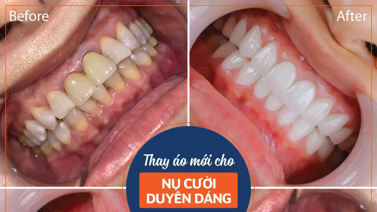 Phương pháp tẩy trắng răng nào được ưu chuộng nhất?
