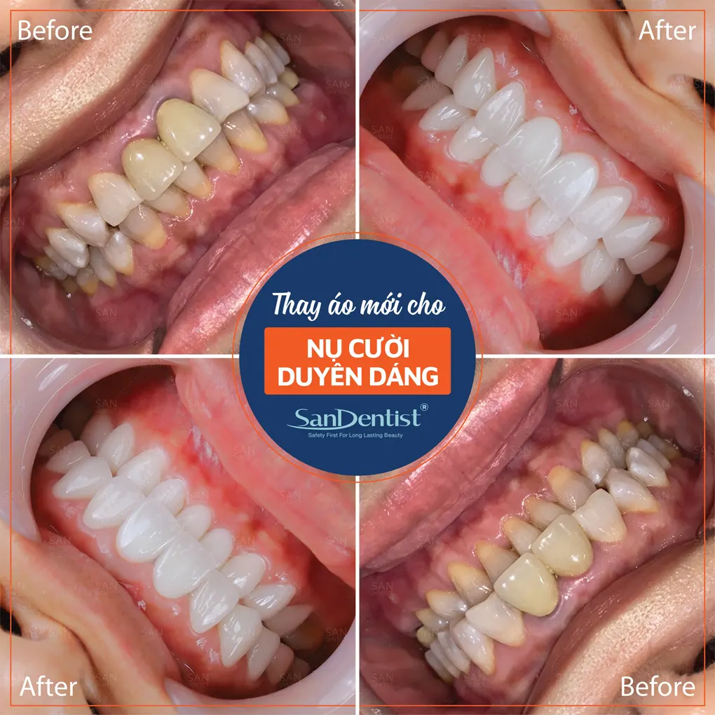 Phương pháp tẩy trắng răng nào được ưu chuộng nhất?