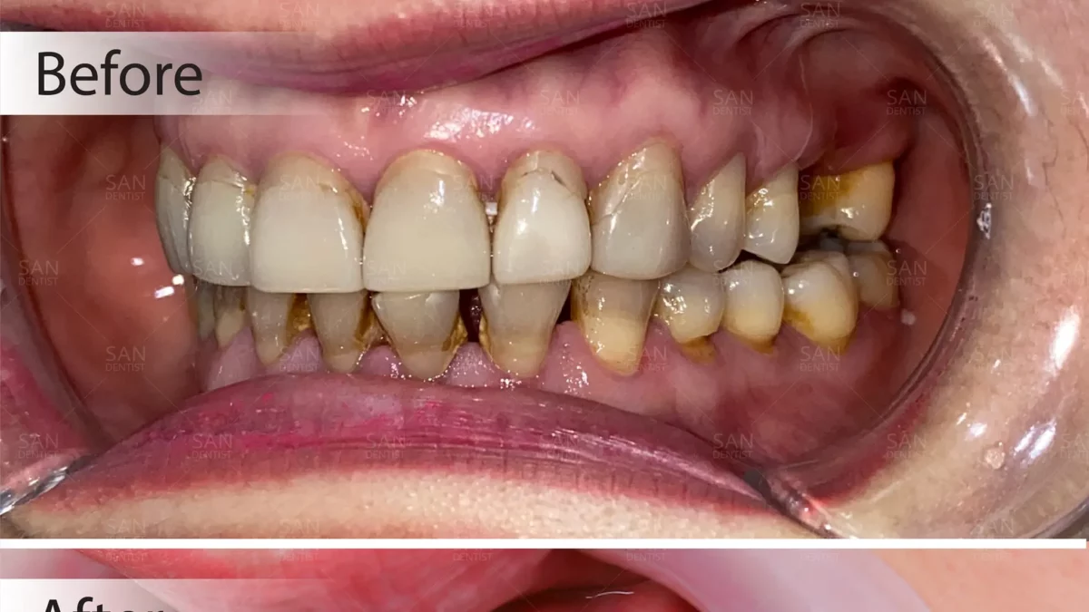 Răng cấm bị lung lay có nên nhổ không?