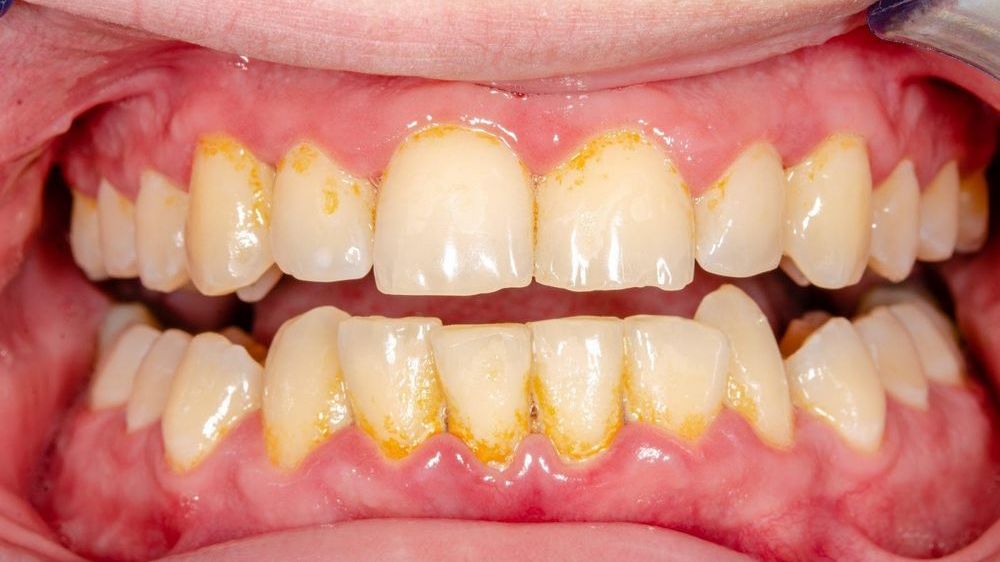 Ăn gì, vệ sinh ra sao để ngăn cao răng tái phát?