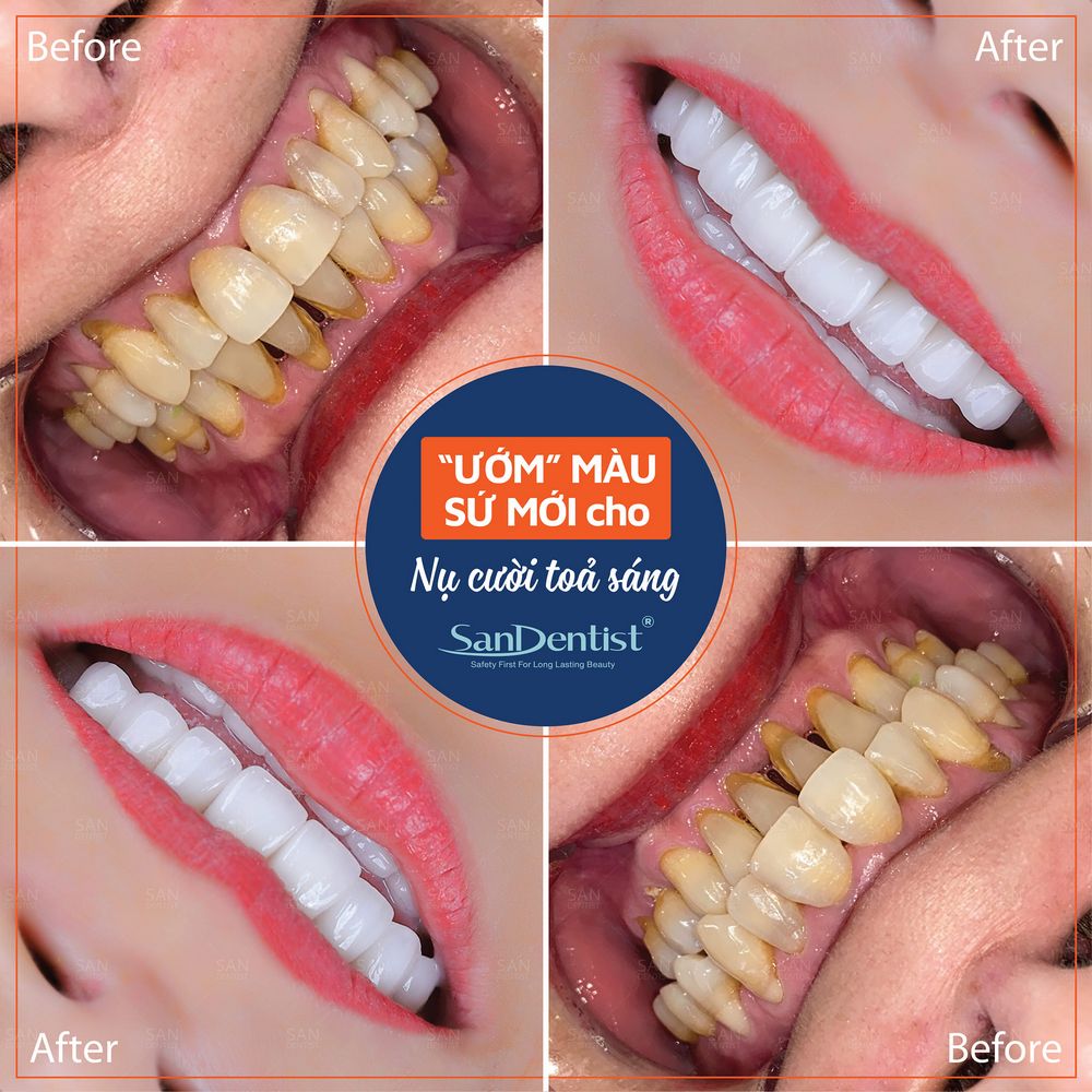 Ăn gì, vệ sinh ra sao để ngăn cao răng tái phát?