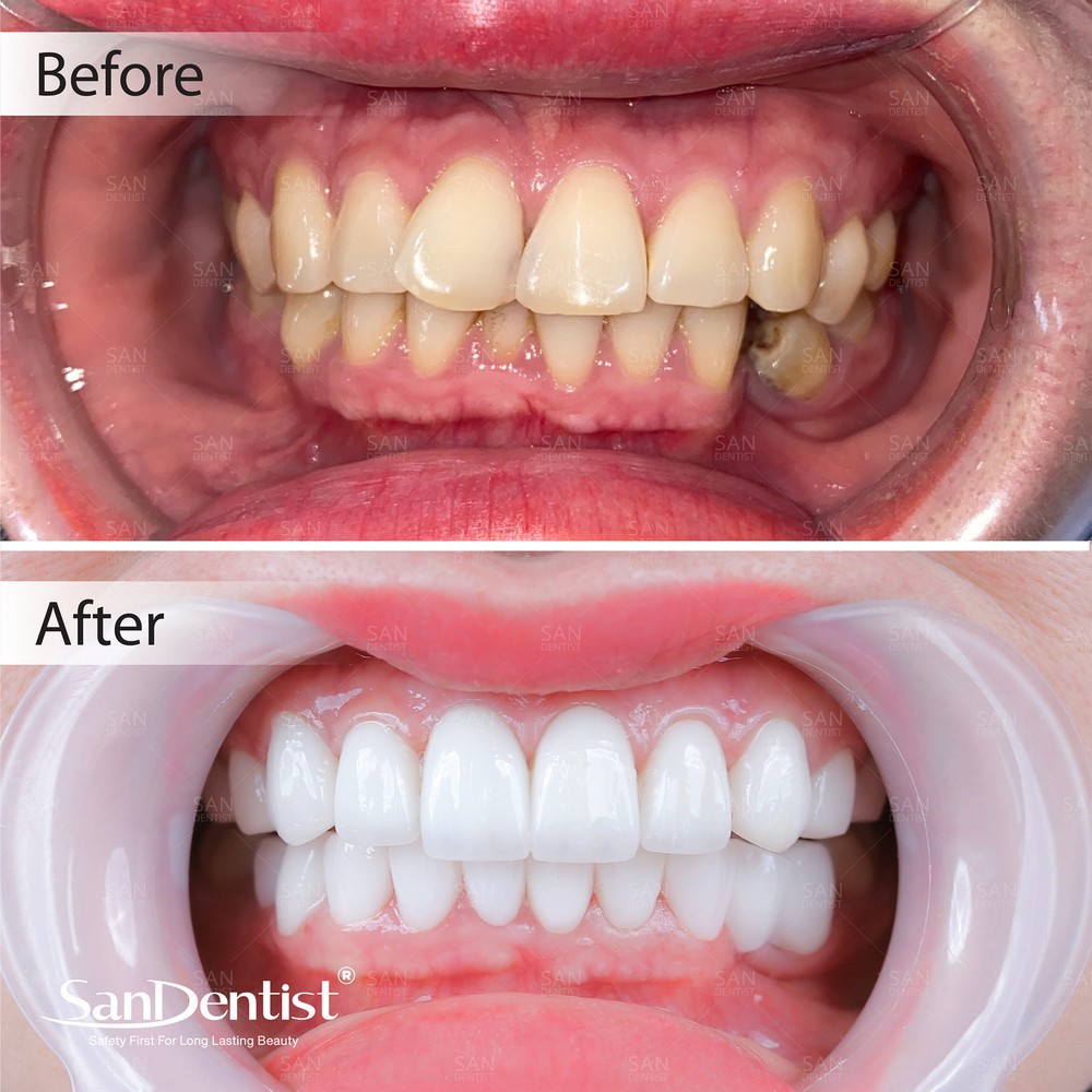 Cạo vôi răng có thực sự giúp răng trắng sáng?