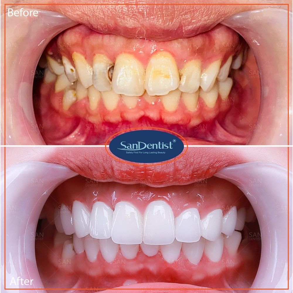 Các giai đoạn của bệnh viêm tủy răng có dấu hiệu ra sao?