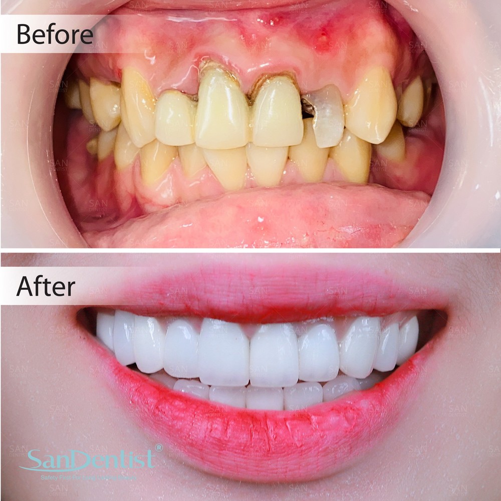 Các giai đoạn của bệnh viêm tủy răng có dấu hiệu ra sao?