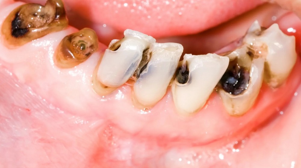 Các giai đoạn của bệnh viêm tủy răng có dấu hiệu ra sao?