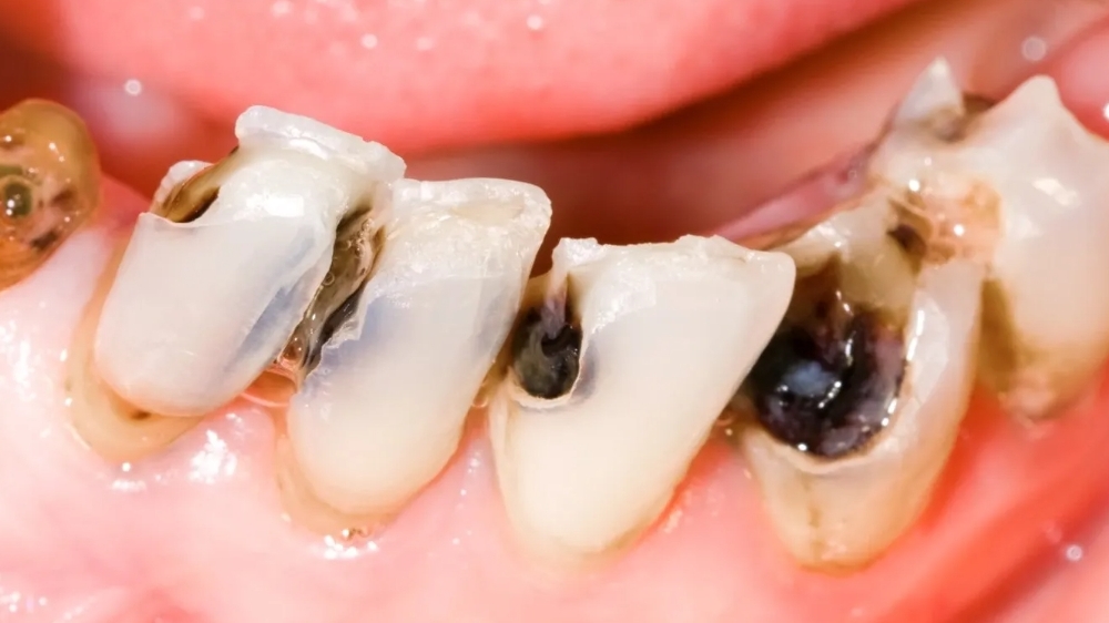 Các giai đoạn của bệnh viêm tủy răng có dấu hiệu ra sao?